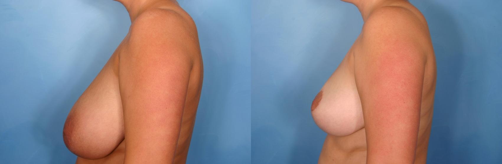 Before & After Breast Reduction Case 83 View #2 View in Naples and Ft. Myers, FL