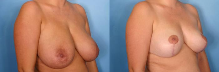 Before & After Breast Reduction Case 83 View #3 View in Naples and Ft. Myers, FL