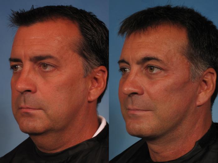 Before & After Brow Lift Case 208 View #2 View in Naples and Ft. Myers, FL