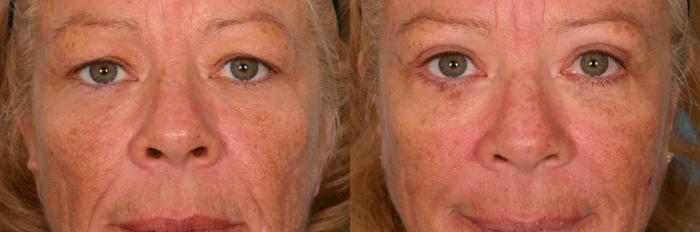 Before & After Brow Lift Case 54 View #1 View in Naples and Ft. Myers, FL