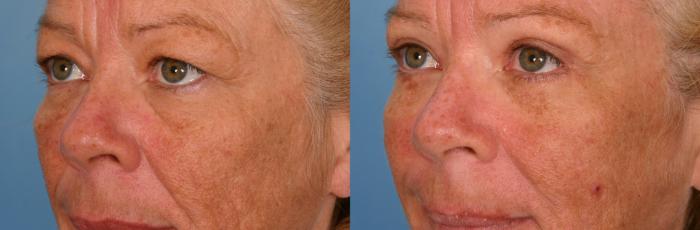Before & After Brow Lift Case 54 View #2 View in Naples and Ft. Myers, FL