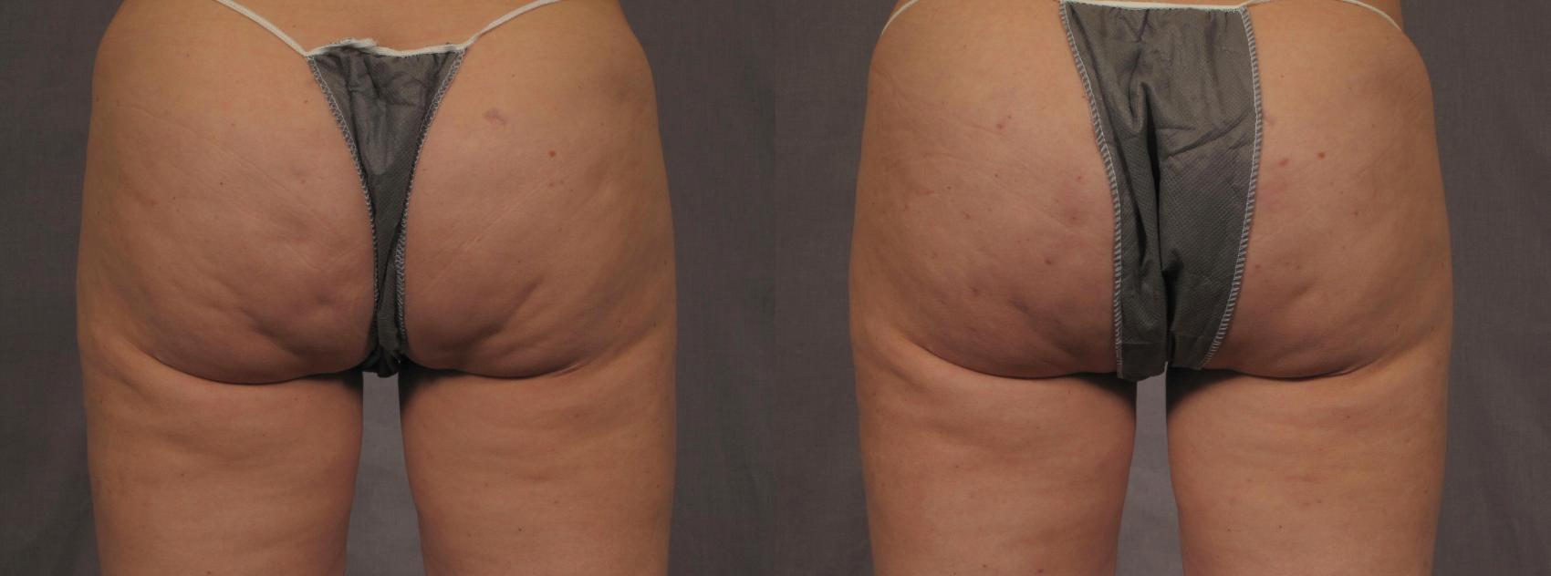Before & After Cellfina Case 288 View #1 View in Naples and Ft. Myers, FL