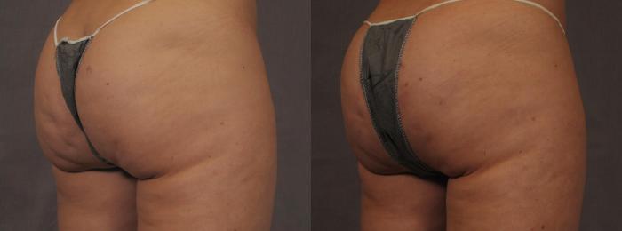 Before & After Cellfina Case 288 View #3 View in Naples and Ft. Myers, FL