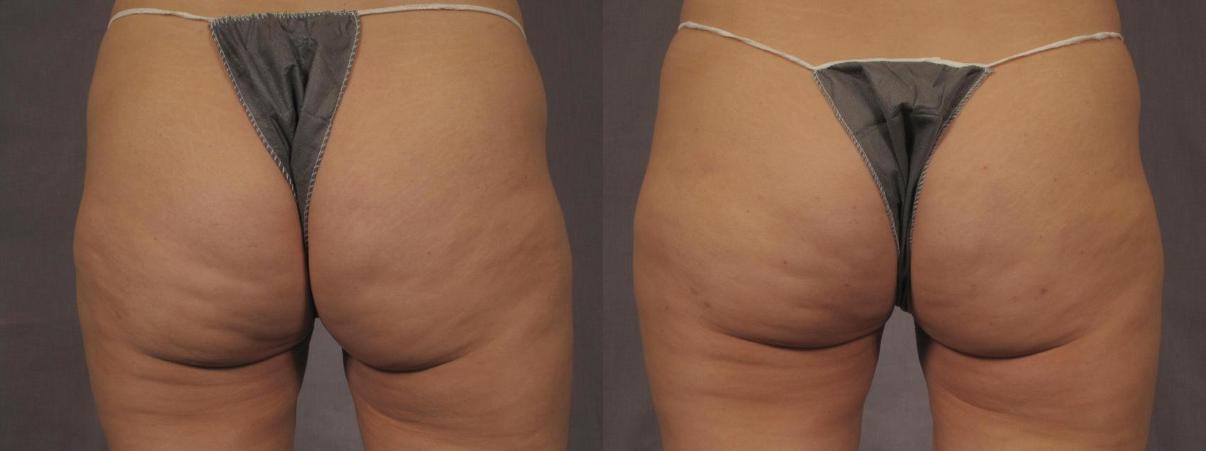Before & After Cellfina Cellulite Reduction Case 287 View #1 View in Naples and Ft. Myers, FL