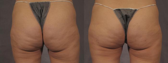 Before & After Cellfina Cellulite Reduction Case 287 View #1 View in Naples and Ft. Myers, FL