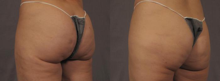 Before & After Cellfina Cellulite Reduction Case 287 View #2 View in Naples and Ft. Myers, FL