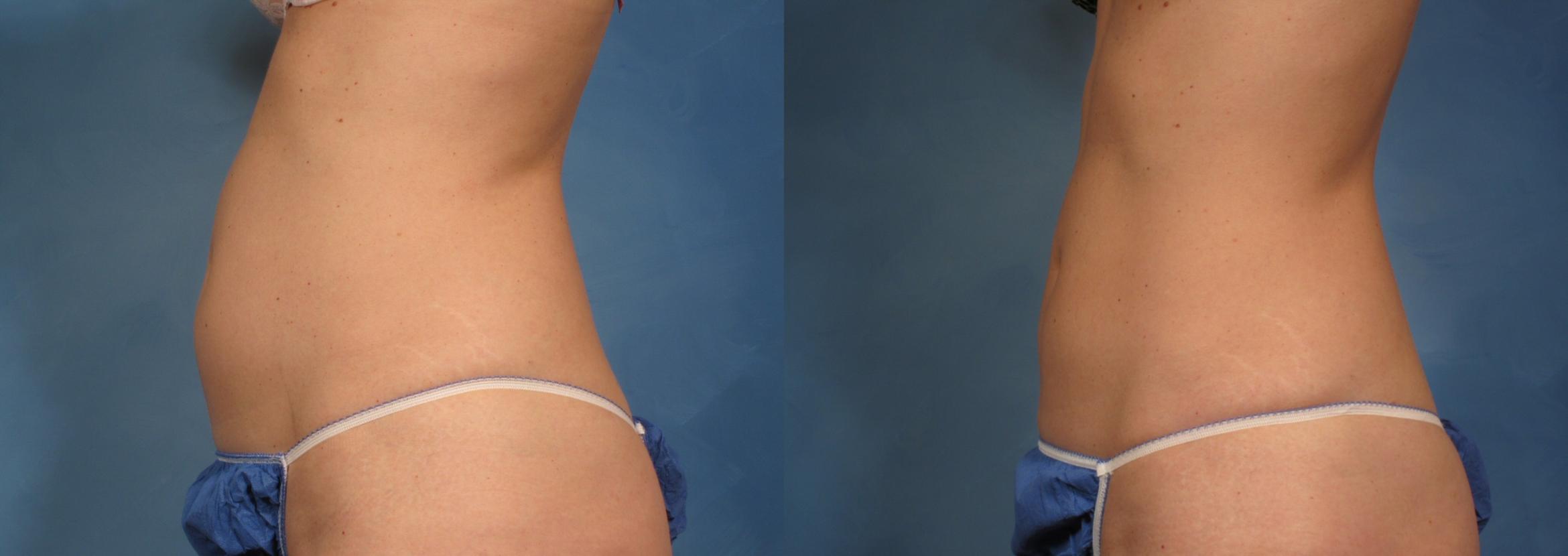 Before & After CoolSculpting® Elite Case 139 View #1 View in Naples, FL