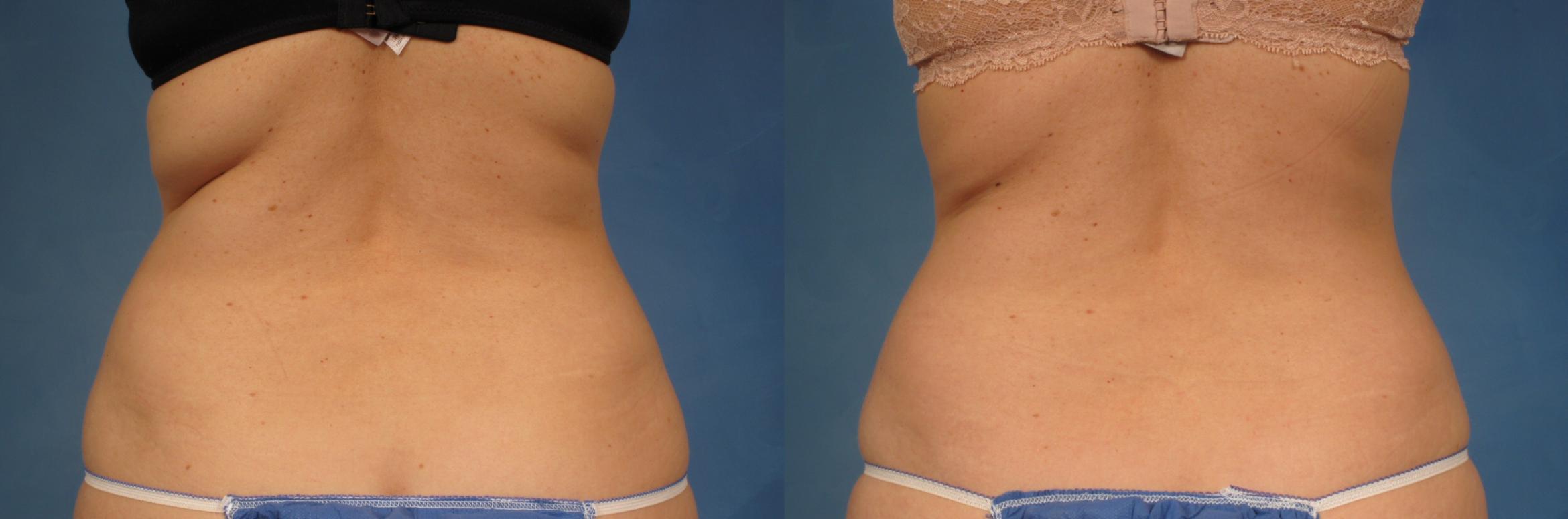 Before & After CoolSculpting Elite Case 164 View #1 View in Naples, FL