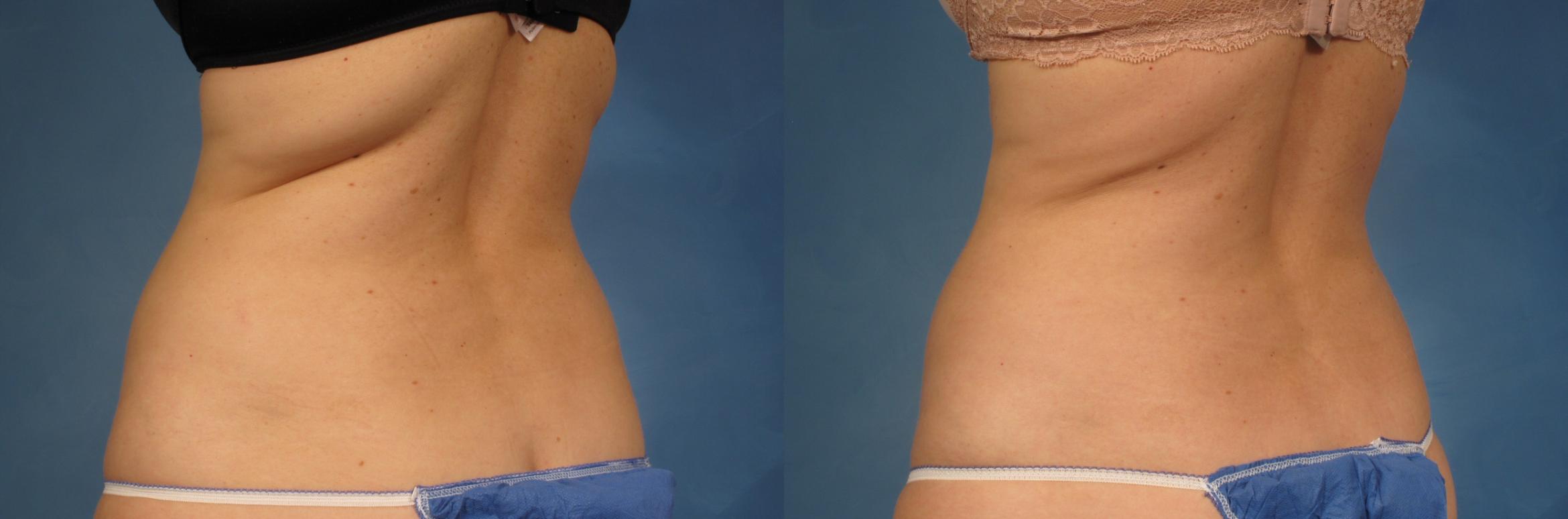 Before & After CoolSculpting Elite Case 164 View #2 View in Naples, FL