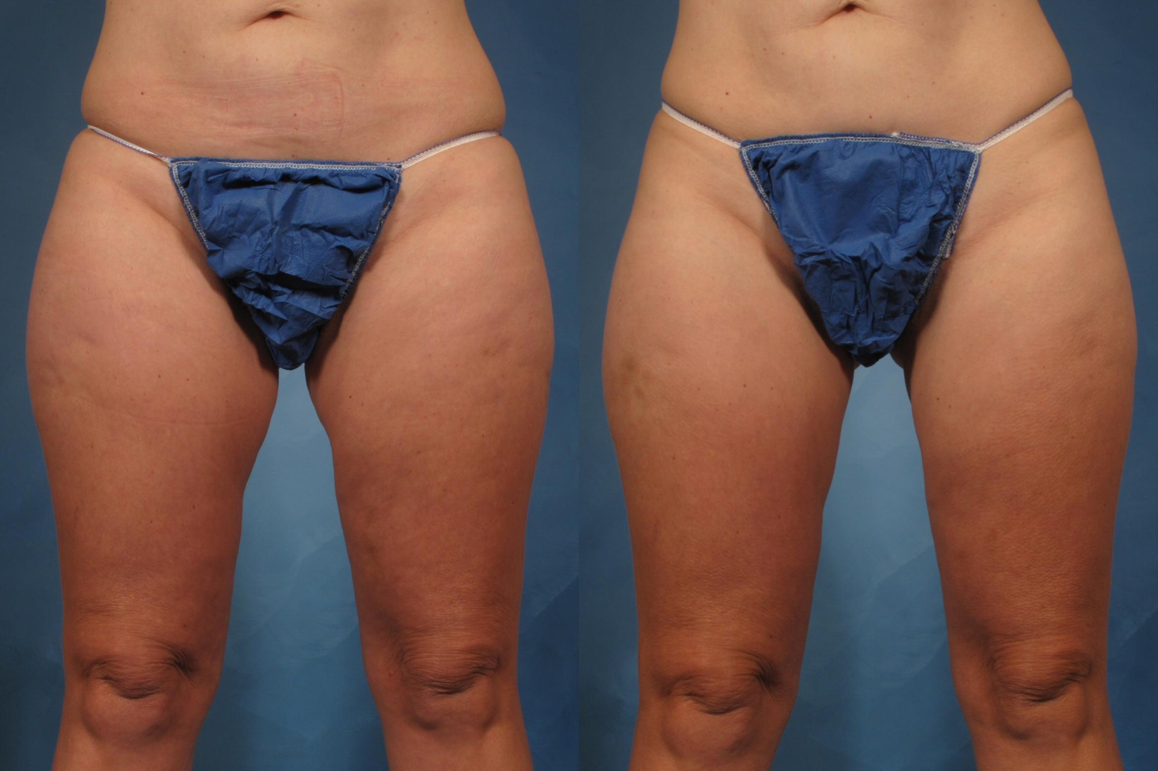 Before & After CoolSculpting Elite Case 222 View #2 View in Naples, FL