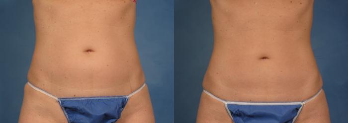 Before & After CoolSculpting® Elite Case 139 View #2 View in Naples and Ft. Myers, FL
