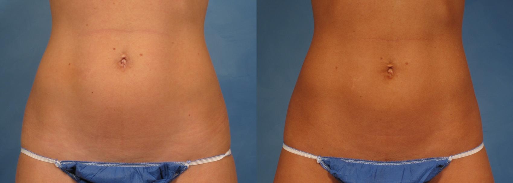 Before & After CoolSculpting Elite Case 146 View #1 View in Naples and Ft. Myers, FL