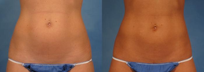 Before & After CoolSculpting Elite Case 146 View #1 View in Naples and Ft. Myers, FL
