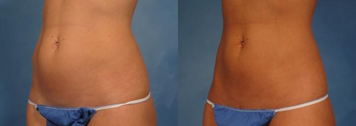 Before & After CoolSculpting Elite Case 146 View #2 View in Naples and Ft. Myers, FL
