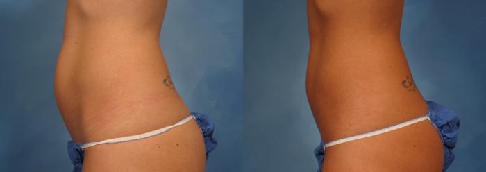 Before & After CoolSculpting Elite Case 146 View #3 View in Naples and Ft. Myers, FL
