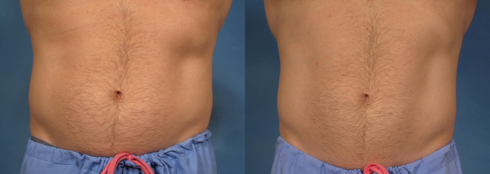 Before & After CoolSculpting Elite Case 153 View #1 View in Naples and Ft. Myers, FL