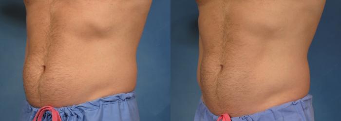 Before & After CoolSculpting Elite Case 153 View #2 View in Naples and Ft. Myers, FL