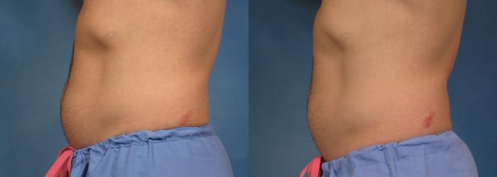 Before & After CoolSculpting Elite Case 153 View #3 View in Naples and Ft. Myers, FL