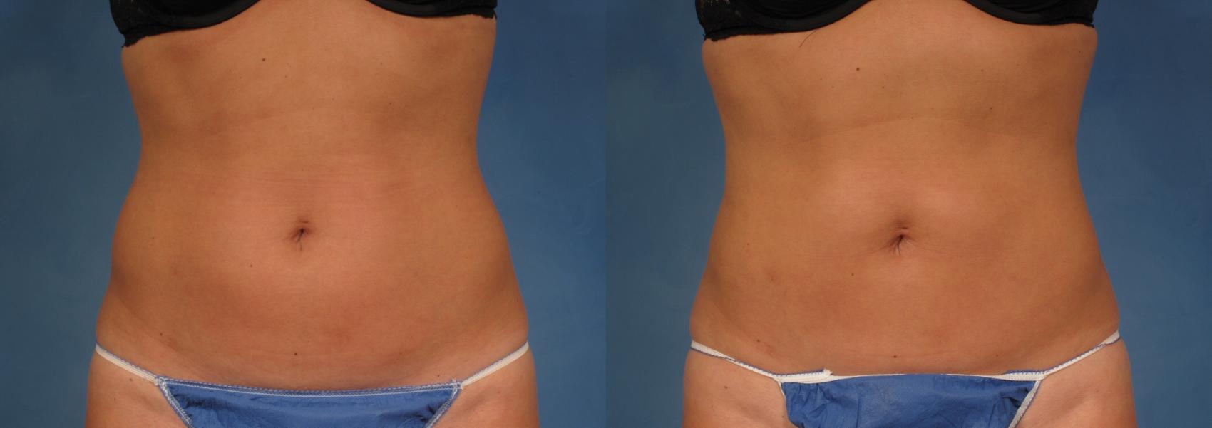 Before & After CoolSculpting Elite Case 154 View #1 View in Naples and Ft. Myers, FL