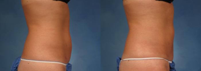 Before & After CoolSculpting Elite Case 154 View #2 View in Naples and Ft. Myers, FL