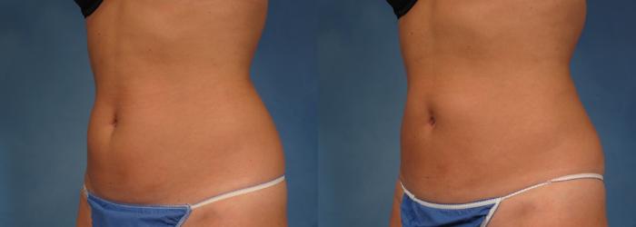 Before & After CoolSculpting Elite Case 154 View #3 View in Naples and Ft. Myers, FL