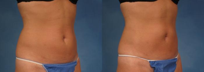 Before & After CoolSculpting Elite Case 154 View #4 View in Naples and Ft. Myers, FL