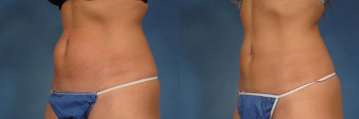 Before & After CoolSculpting Elite Case 155 View #1 View in Naples and Ft. Myers, FL