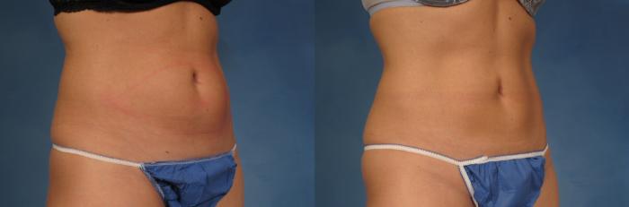 Before & After CoolSculpting Elite Case 155 View #2 View in Naples and Ft. Myers, FL