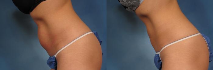 Before & After CoolSculpting Elite Case 155 View #4 View in Naples and Ft. Myers, FL