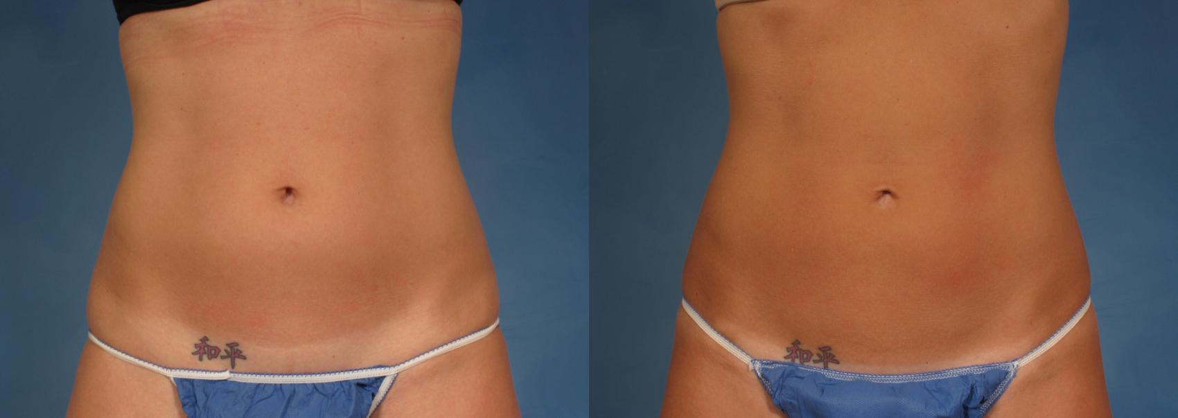 Before & After CoolSculpting® Elite Case 167 View #1 View in Naples and Ft. Myers, FL