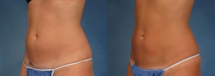 Before & After CoolSculpting® Elite Case 167 View #2 View in Naples and Ft. Myers, FL
