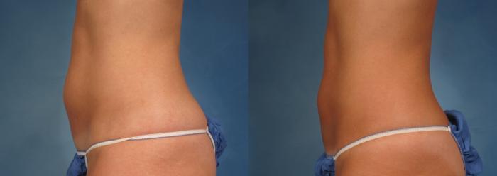 Before & After CoolSculpting® Elite Case 167 View #3 View in Naples and Ft. Myers, FL