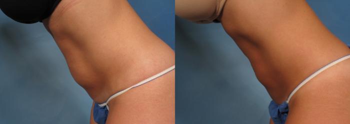 Before & After CoolSculpting® Elite Case 167 View #4 View in Naples and Ft. Myers, FL