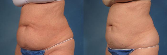 Before & After CoolSculpting Elite Case 190 View #2 View in Naples and Ft. Myers, FL