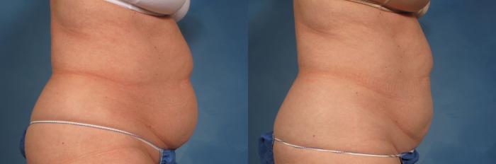 Before & After CoolSculpting Elite Case 190 View #3 View in Naples and Ft. Myers, FL