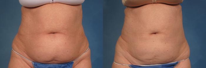 Before & After CoolSculpting Elite Case 190 View #4 View in Naples and Ft. Myers, FL
