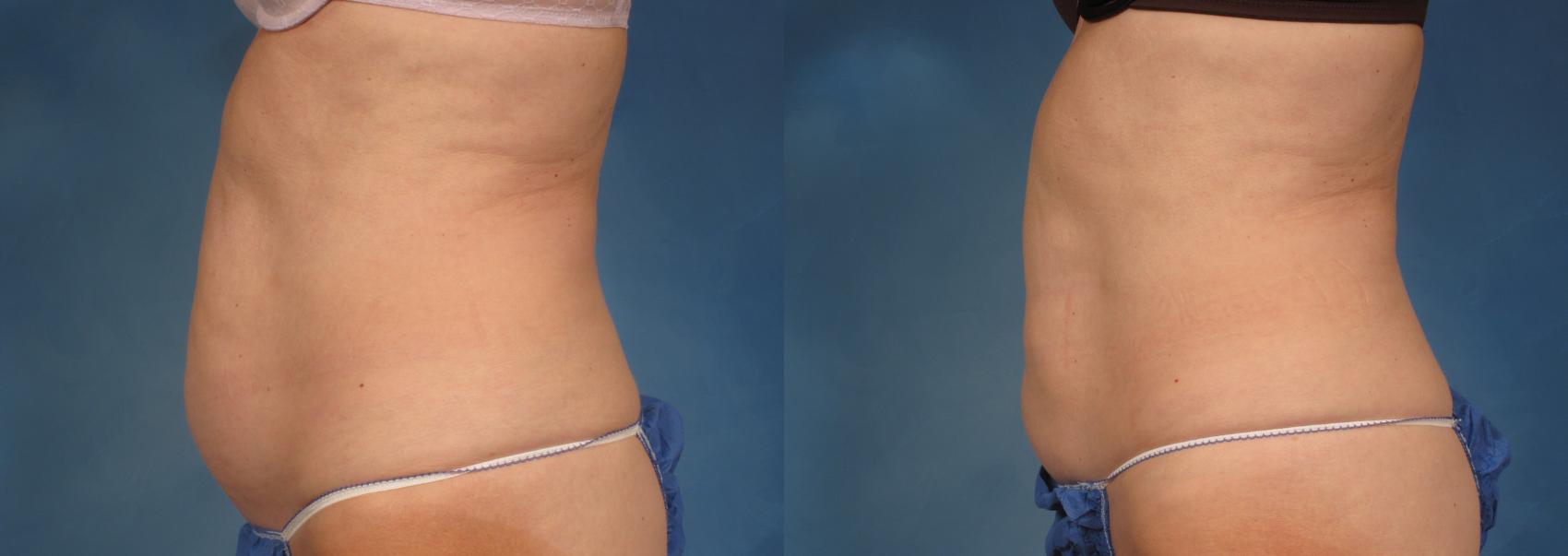 CoolSculpting Elite in Medford and Grants Pass, Oregon