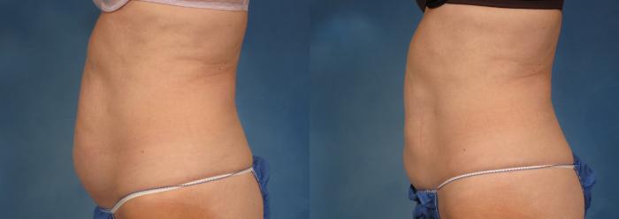 Before & After CoolSculpting® Elite Case 195 View #1 View in Naples and Ft. Myers, FL