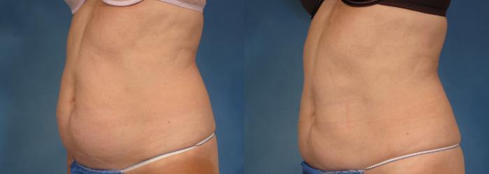 Before & After CoolSculpting® Elite Case 195 View #2 View in Naples and Ft. Myers, FL