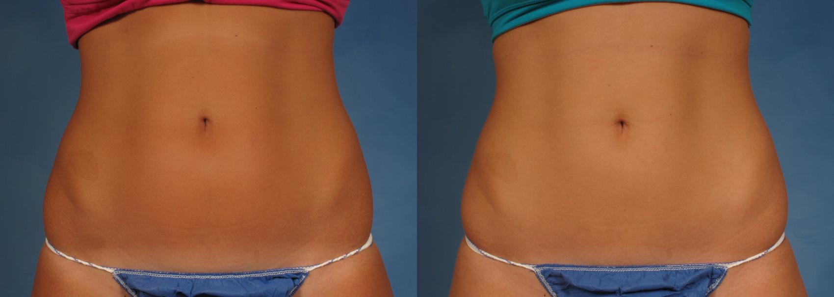 Before & After CoolSculpting Elite Case 198 View #1 View in Naples and Ft. Myers, FL