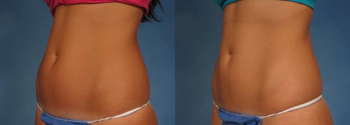 Before & After CoolSculpting Elite Case 198 View #2 View in Naples and Ft. Myers, FL
