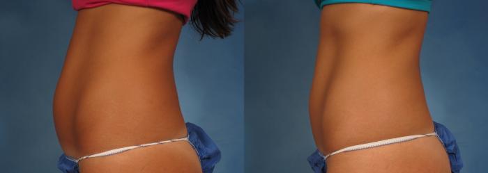Before & After CoolSculpting Elite Case 198 View #3 View in Naples and Ft. Myers, FL