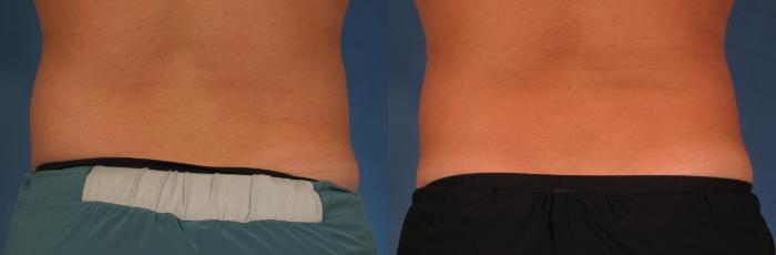 Before & After CoolSculpting® Elite Case 209 View #1 View in Naples and Ft. Myers, FL