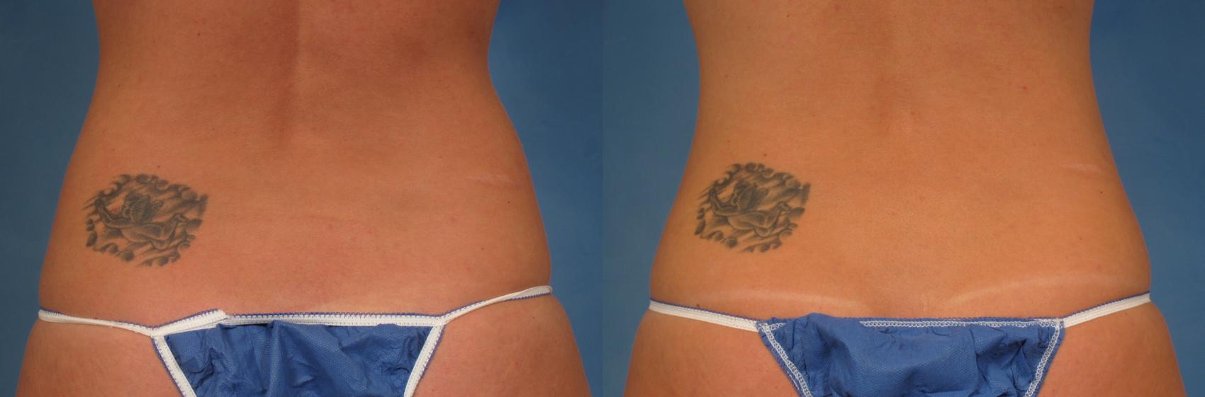 CoolSculpting, Brazilian Body Contouring Knoxville