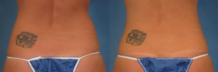 Before & After CoolSculpting® Elite Case 210 View #1 View in Naples and Ft. Myers, FL