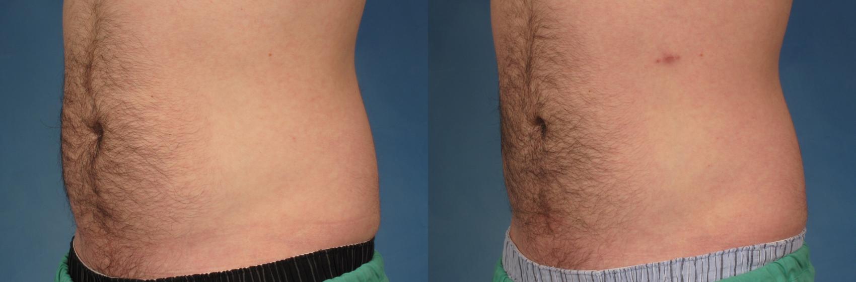 Before & After CoolSculpting Elite Case 211 View #1 View in Naples and Ft. Myers, FL