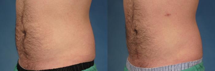 Before & After CoolSculpting Elite Case 211 View #1 View in Naples and Ft. Myers, FL