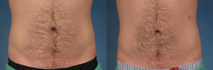 Before & After CoolSculpting Elite Case 211 View #2 View in Naples and Ft. Myers, FL