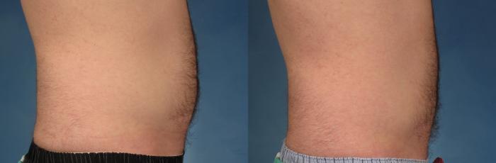 Before & After CoolSculpting Elite Case 211 View #3 View in Naples and Ft. Myers, FL
