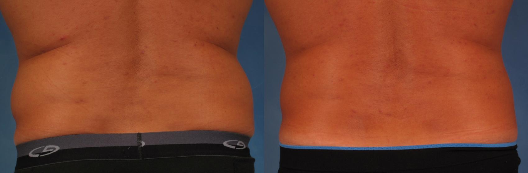 Before & After CoolSculpting Elite Case 212 View #1 View in Naples and Ft. Myers, FL
